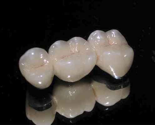 PFM dental bridge - ECONOMY - Derby Dental - posterior teeth