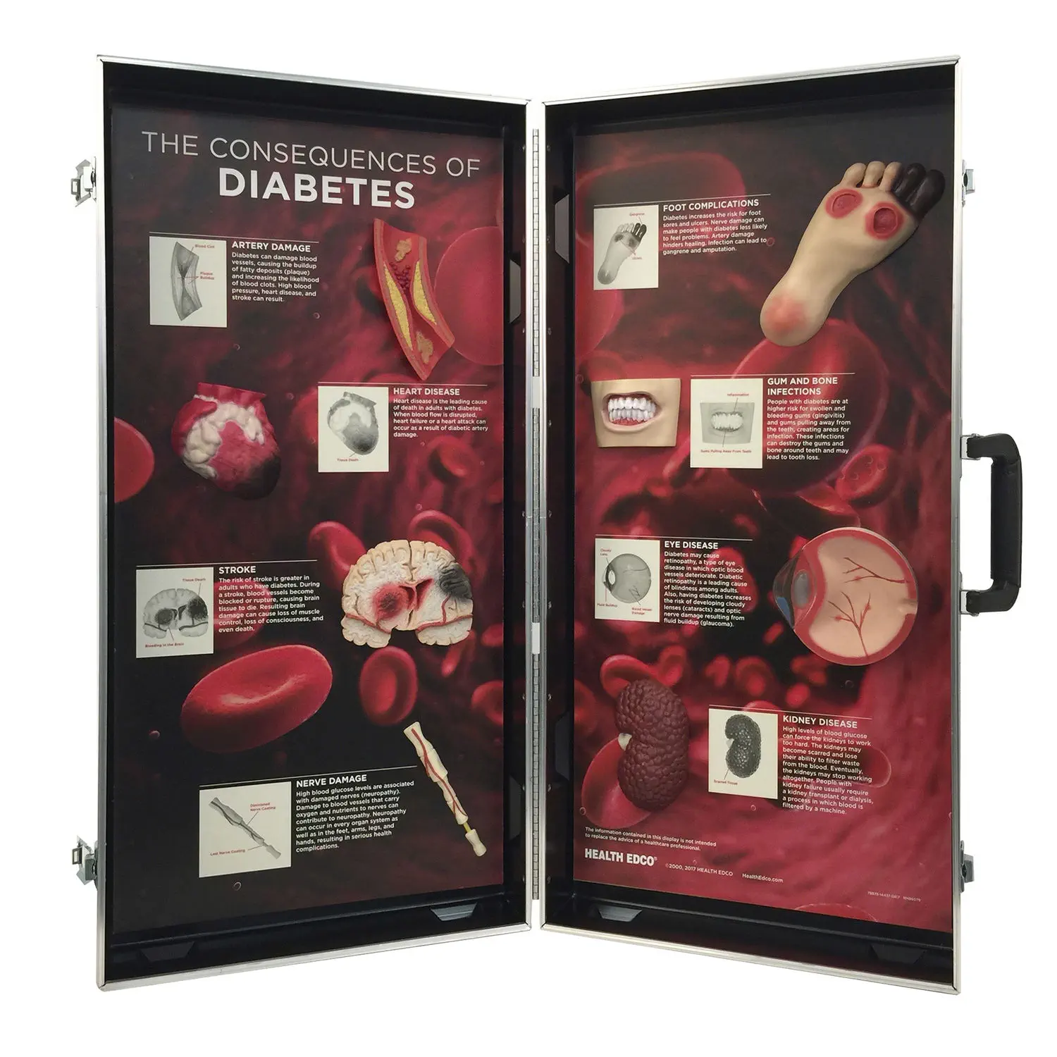 Diabetes model - 78878 - Health Edco & Childbirth Graphics - foot / blood  vessels / kidney
