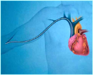 Right atrium catheter - PICC-CATH - HEKA Srl - peripheral / central venous