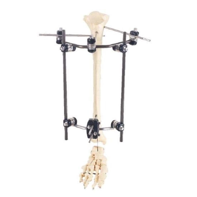 Tibia external fixation system - WZ00 series - Wuhan Yijiabao ...