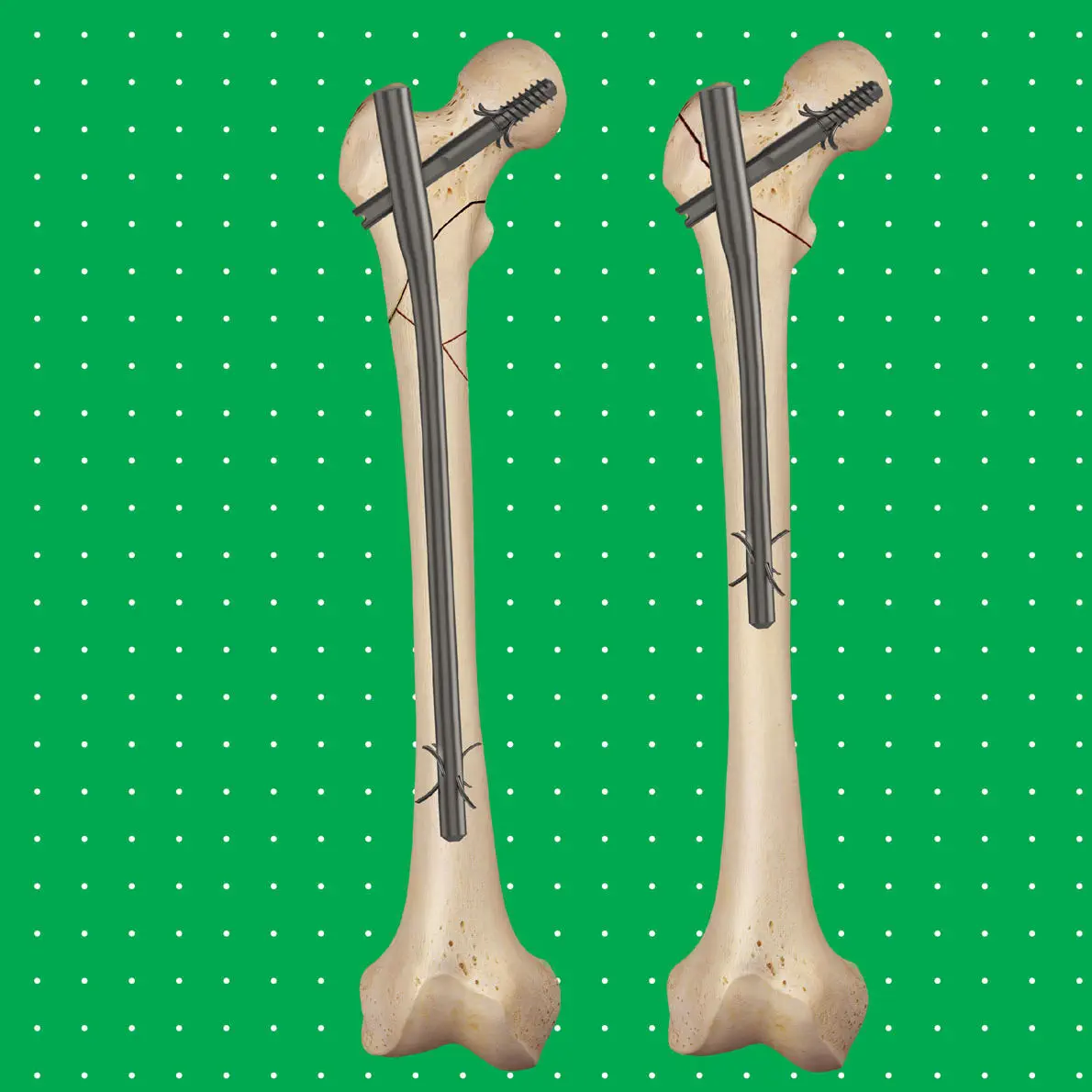 Haste De Titanio No Femur