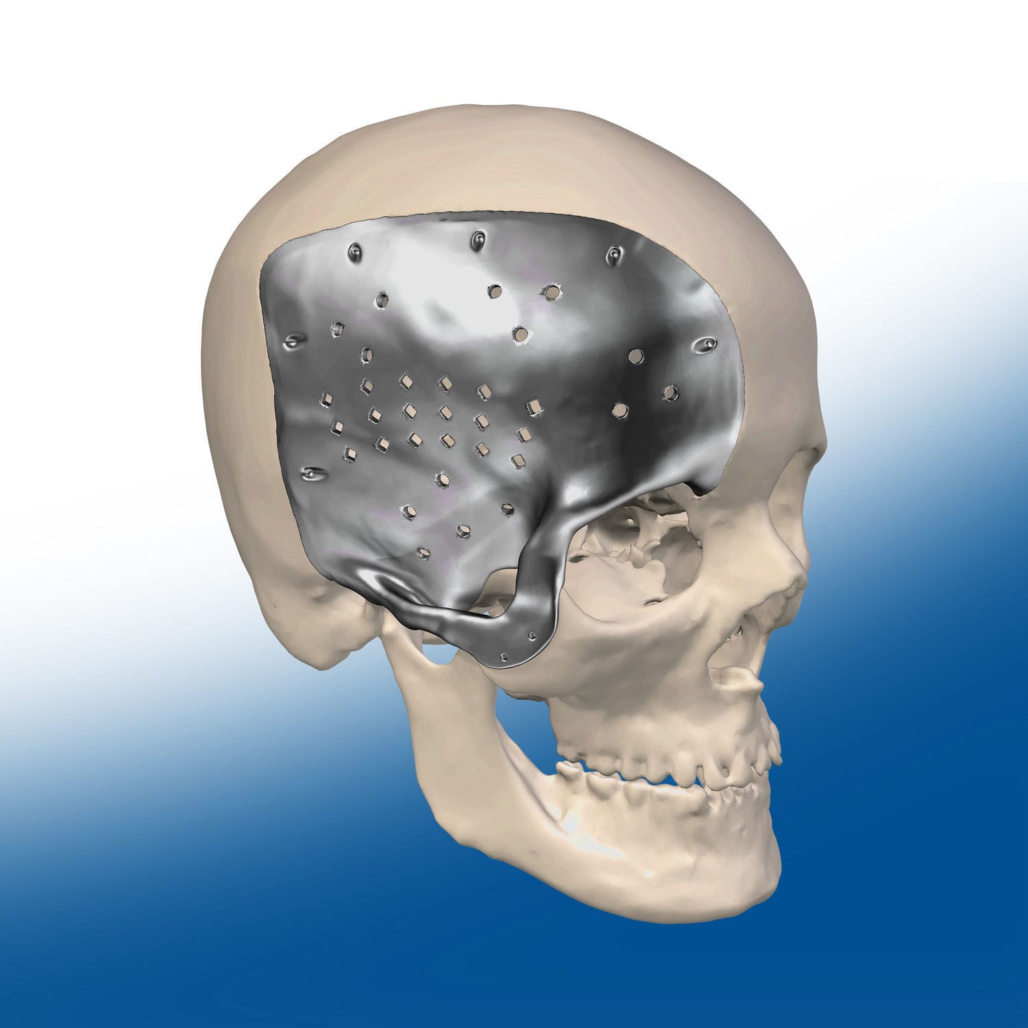 Custom-made cranial implant - Ortho Baltic Implants