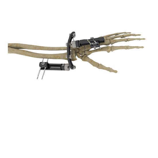 Wrist external fixation system 51340000 Zimed Medical hybrid / adult
