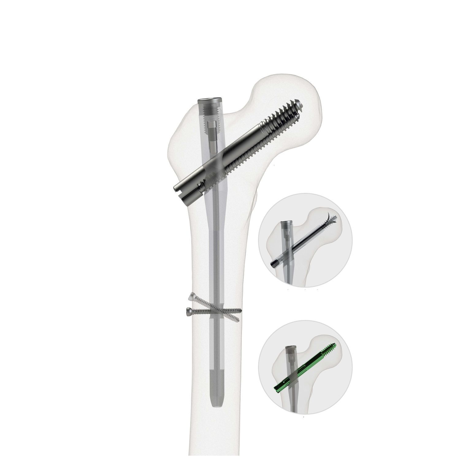 Femoral intramedullary nail - 4552-1017 - Zimed Medical