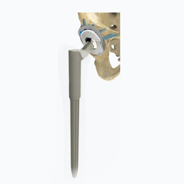 Revision hip prosthesis - Zimed Medical - cementless