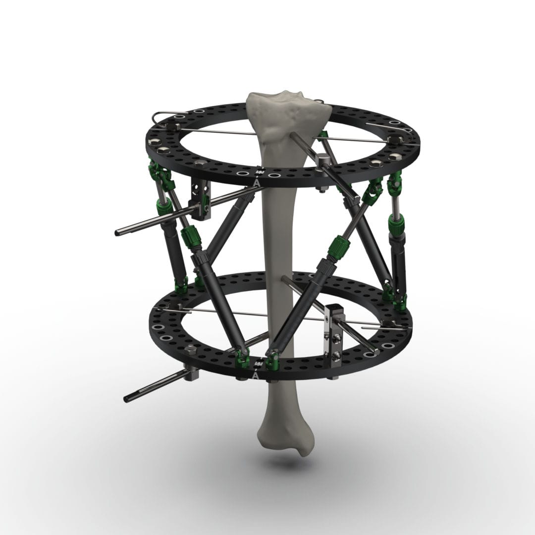 Modular external fixation system - Spider Frame