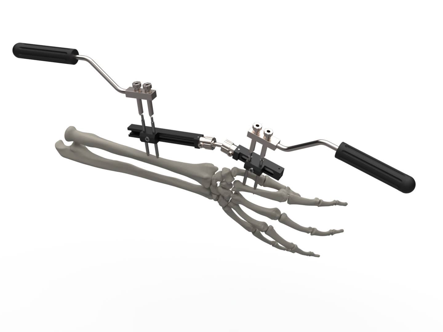 Wrist external fixation system TFERS TASARIMMED radius / ulna
