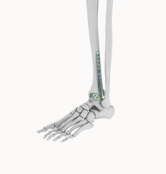 Tibia compression plate - ELT010 - Eonex Medical - distal ...