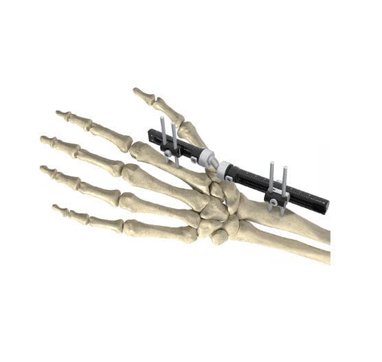Wrist external fixation system Wuxi Betta Medical Technology