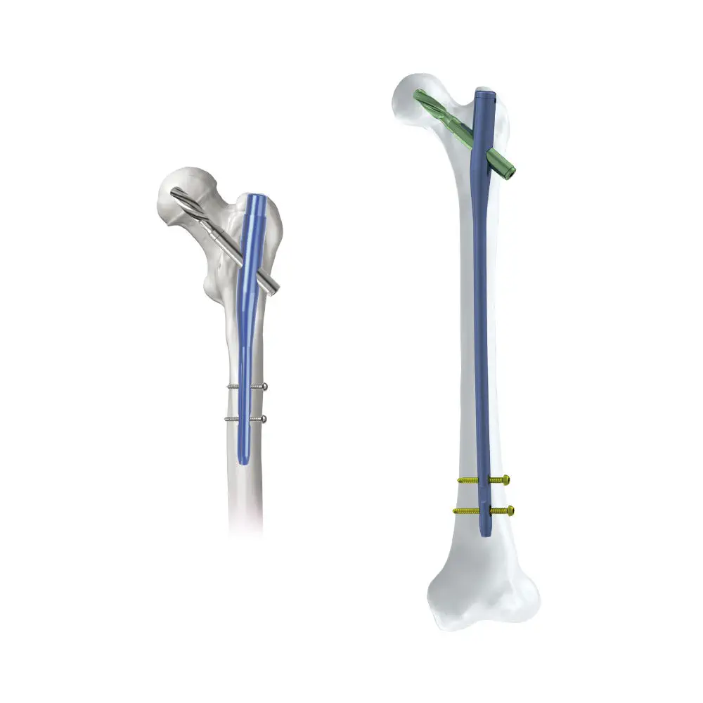 Femoral intramedullary nail - G-T87 - Suzhou Kangli Orthopaedics 