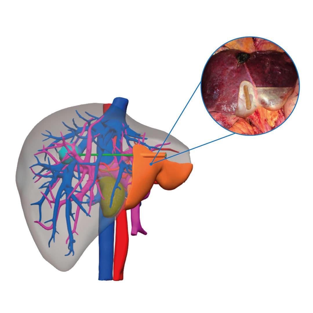Surgical guide Solutions® Cella Medical Solutions