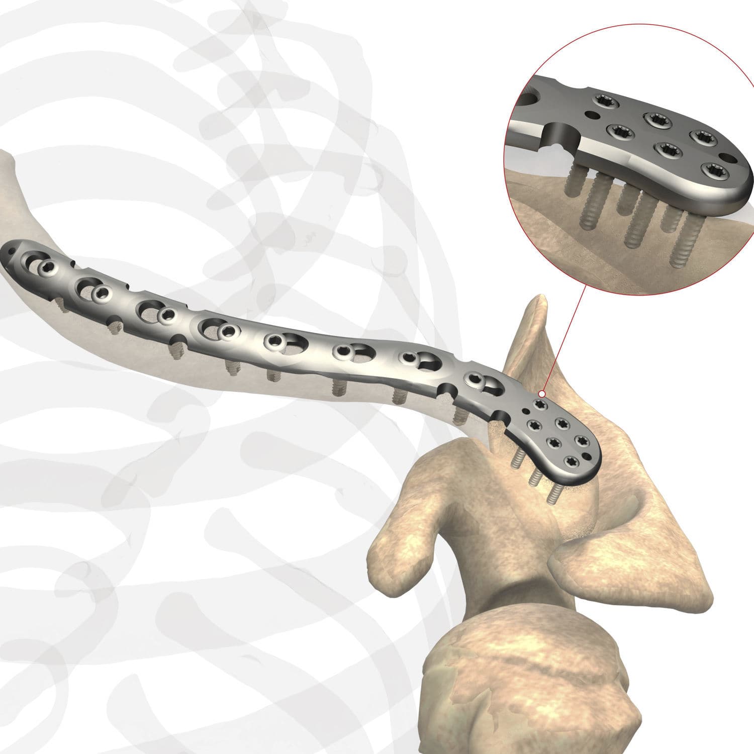 Clavicle Compression Plate As Sh 029 Ases Orthopedics Distal