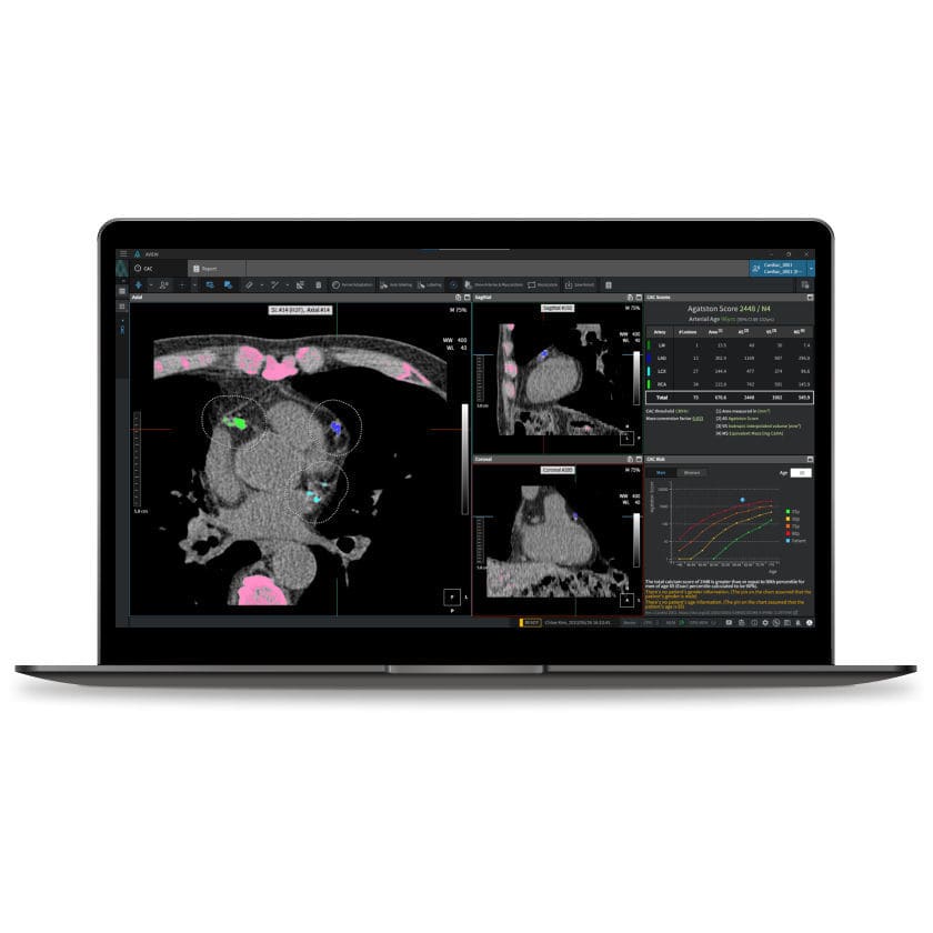 Medical software - CAC - Coreline - CT / cardiovascular / analysis