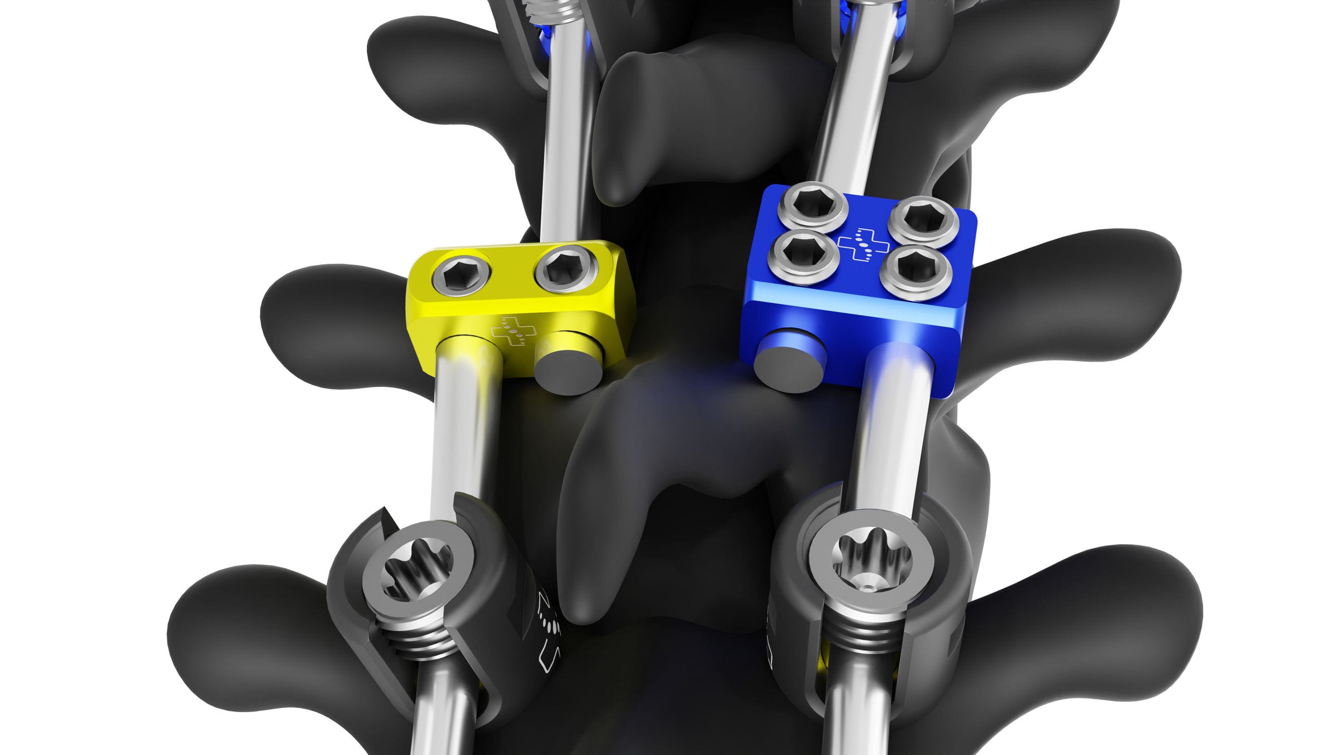 Thoraco-lumbar pedicle screw - 301.01 series - S33 Spine