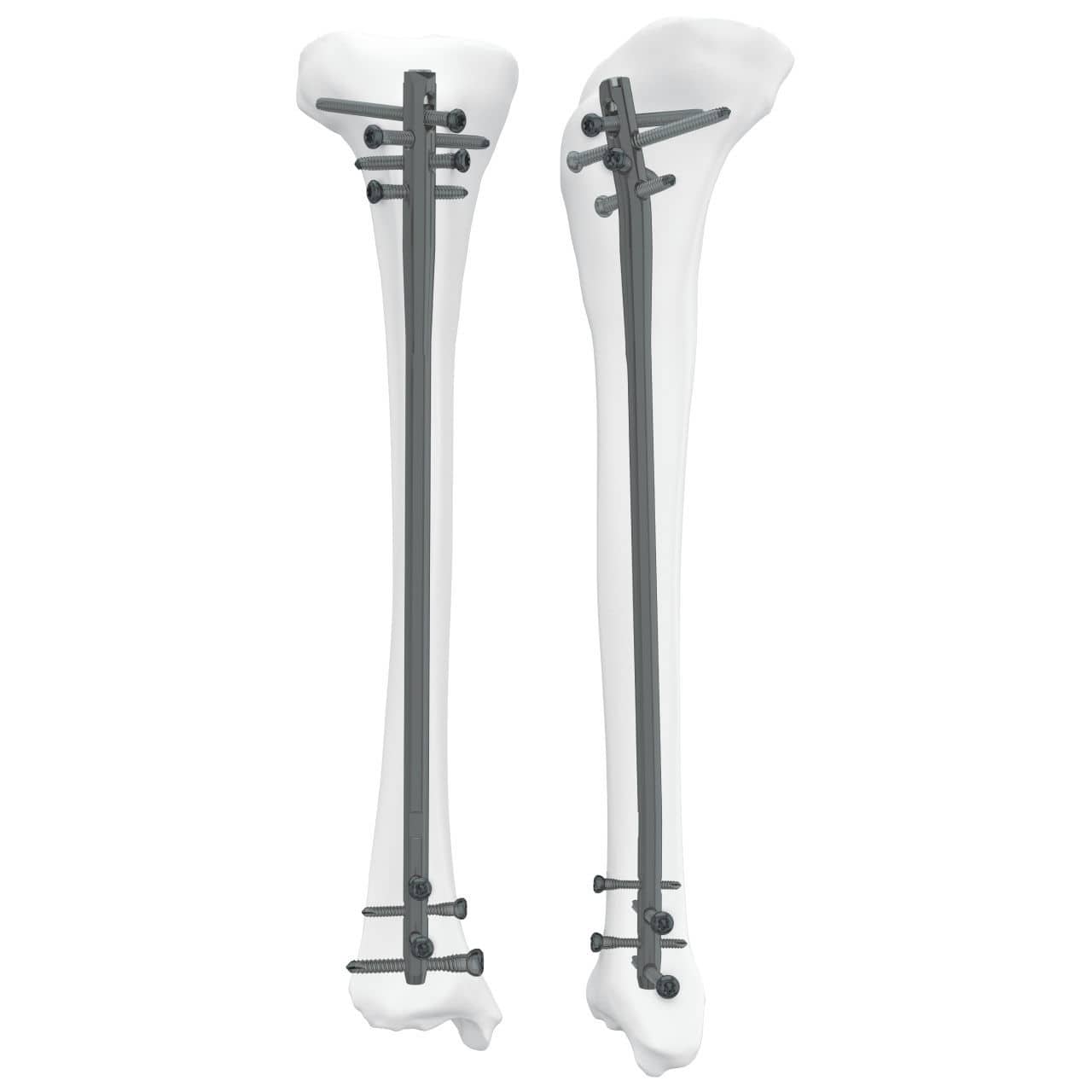 Tibial intramedullary nail - 305050 SPTN - Boneunion Medical - proximal ...