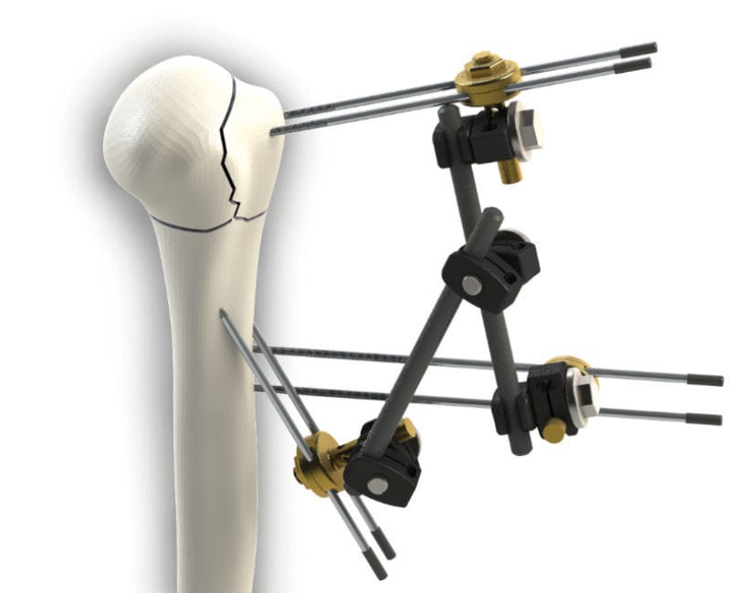 Humerus external fixation system - T-FixUp - DIAL Medicali - tubular ...