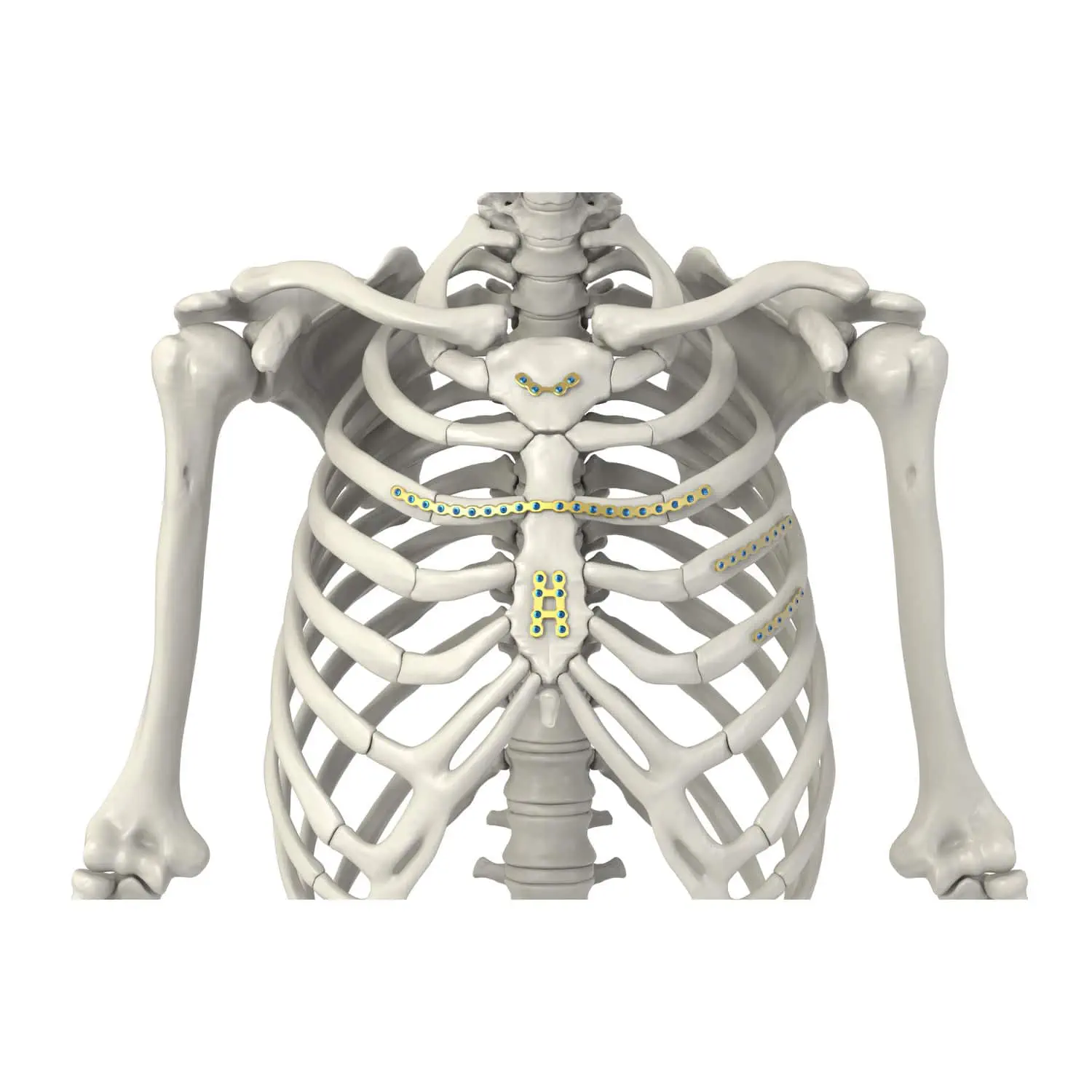 Sternum Compression Plate Arix 2 4 Jeil Medical Corporation Locking Metallic