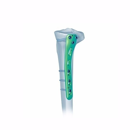 Tibia compression plate - Double Medical Technology - proximal ...