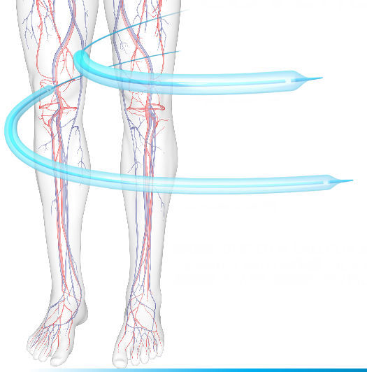 Peripheral Balloons PTA catheter - SABER™ - Cordis - peripheral / balloon / hydrophilic
