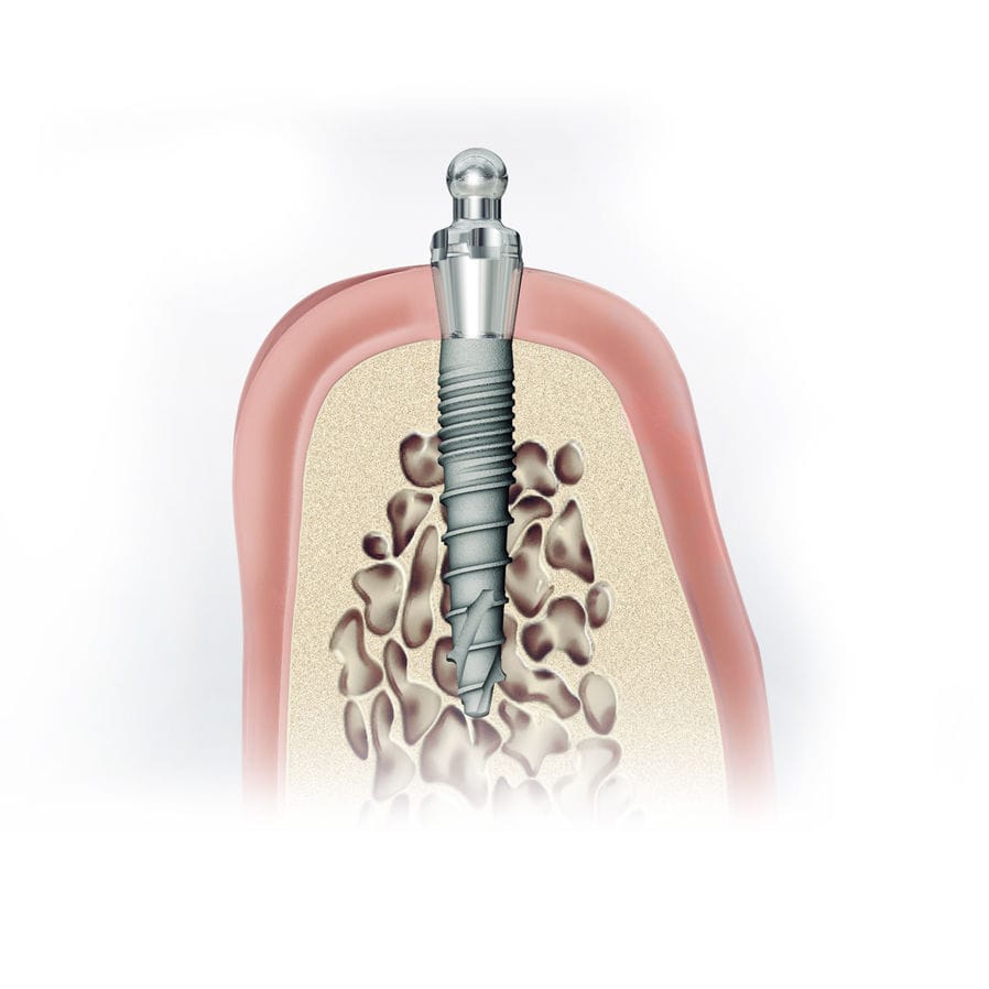 Titanium dental implant CITO mini® DENTAURUM ball / straight / onepiece