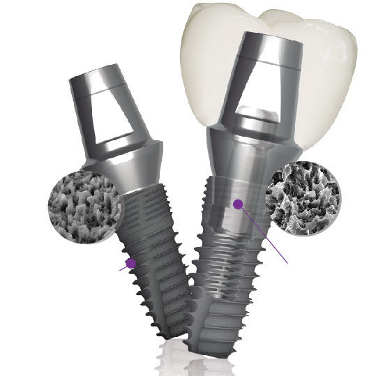 Conical dental implant Implantium II Dentium titanium / internal