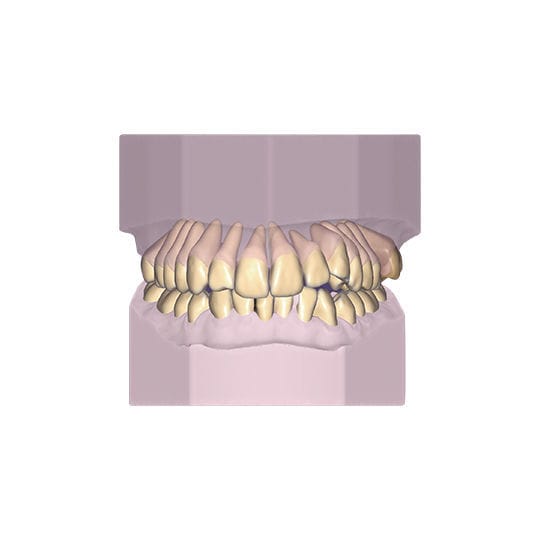 Orthodontic software module Ortho exocad GmbH design / modeling