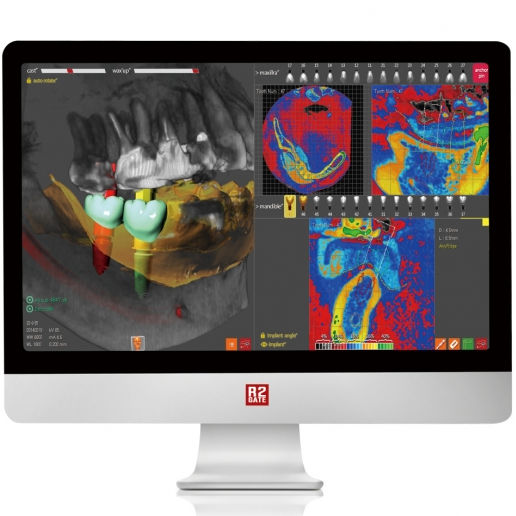 Dental implantology software R2GATE Megagen Implant planning