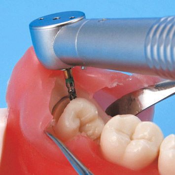 Denture model - SUG1003-UL-SP-FEM-28 - Nissin Dental