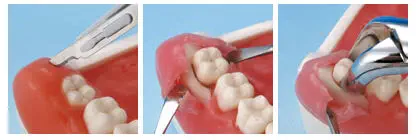 Denture model - SUG1003-UL-SP-FEM-28 - Nissin Dental