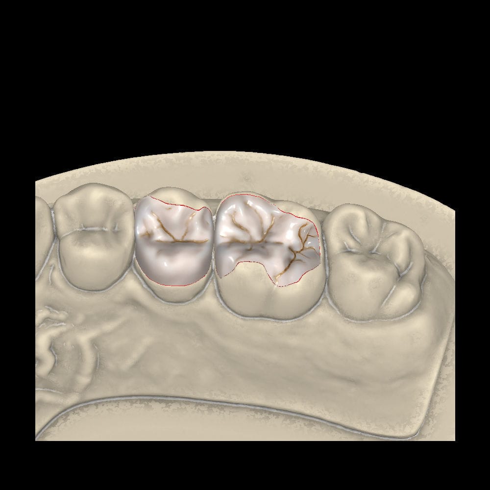 Dental prosthesis design software module - Inlays/Onlays/Veneers ...