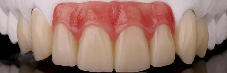 Composite dental material - Gingiva-Composites - Zirkonzahn