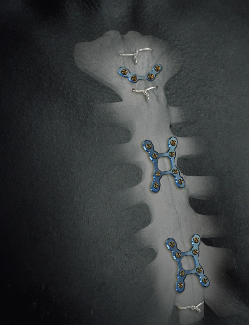 Sternum compression plate SternaLock® Zimmer Biomet locking