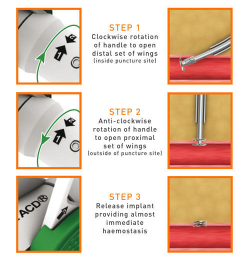 Vascular closure system / with anchor CELT ACD™ Endocor