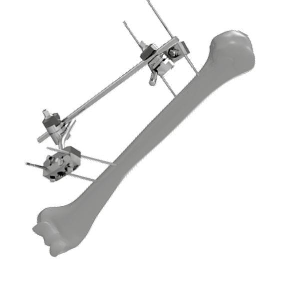 Humerus external fixation system - 206304 - SOFEMED International ...