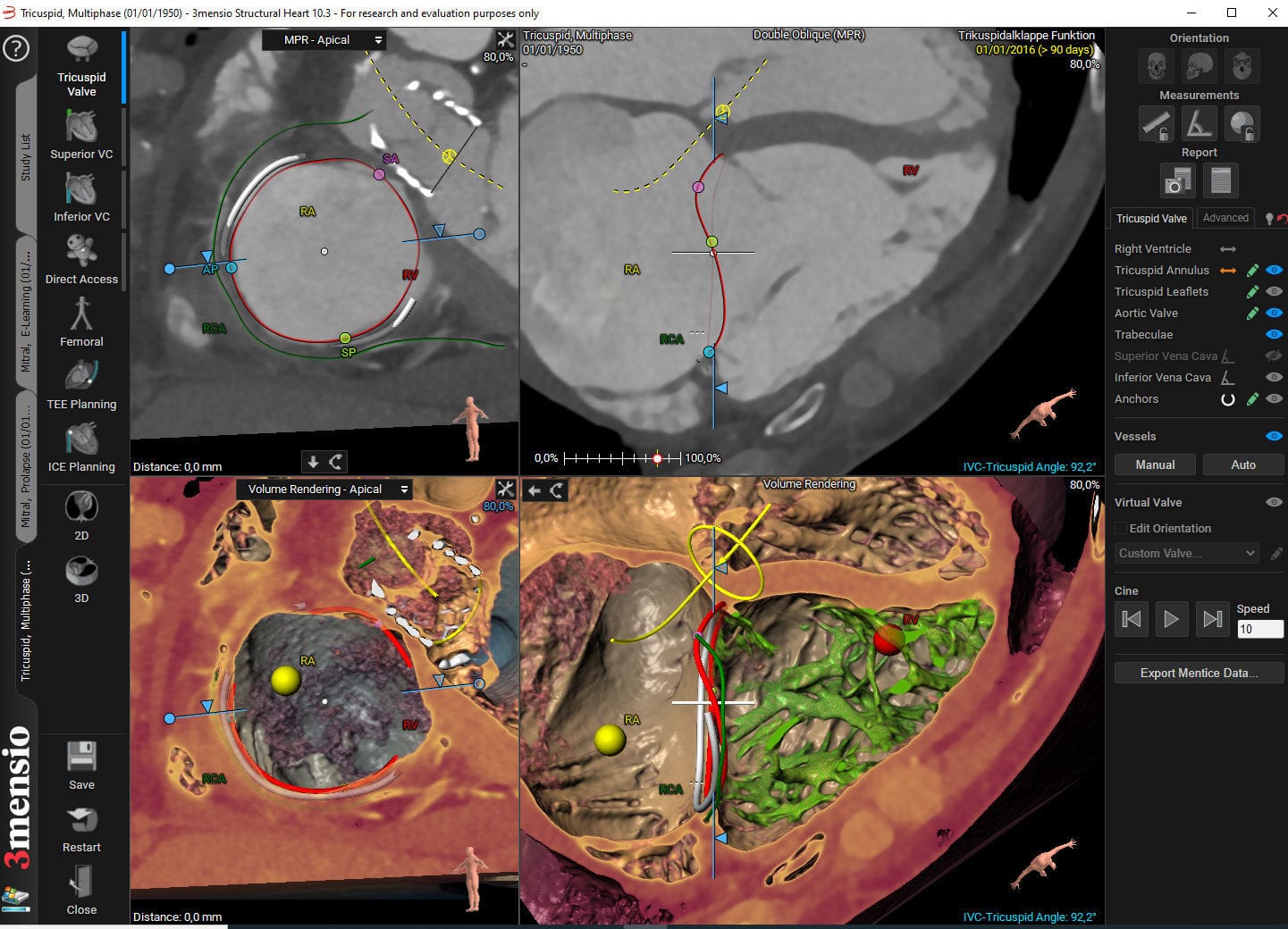 Medical software 3mensio Tricuspid Valve Pie Medical Imaging