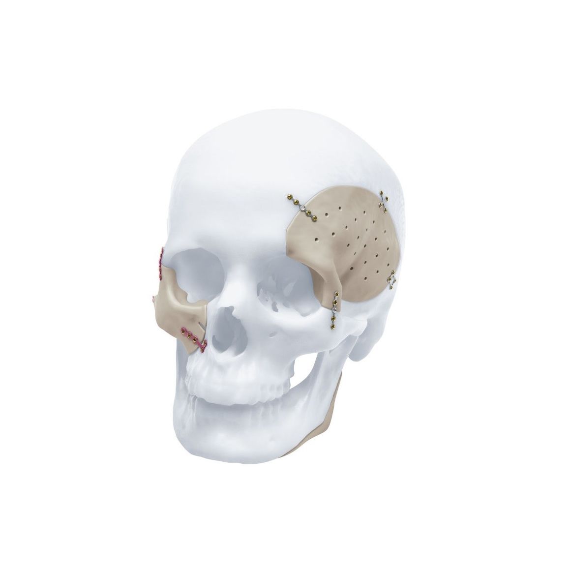 Custommade Cranial Implant Depuy Synthes D18