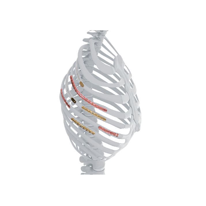 Rib compression plate MatrixRIB™ Depuy Synthes sternal / thoracic