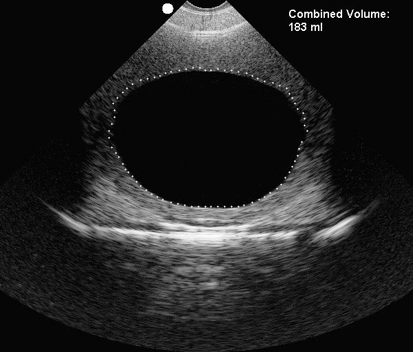 Ultrasound imaging test phantom Yezitronix bladder