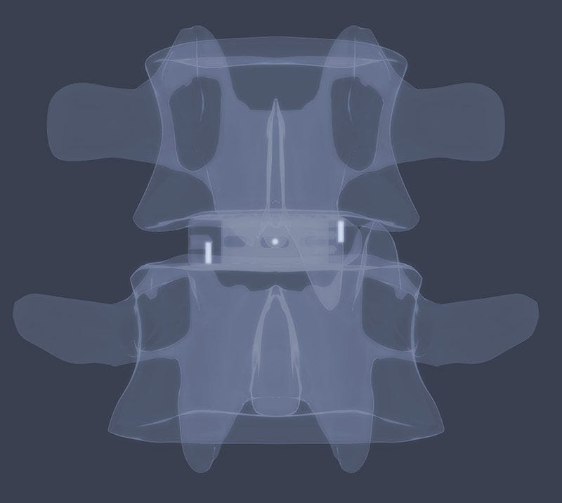 Lumbar interbody fusion cage / transforaminal / PEEK ROIT® LDR