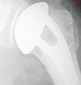 Cemented shoulder prosthesis - AEQUALIS™ FX - Wright Medical Technology