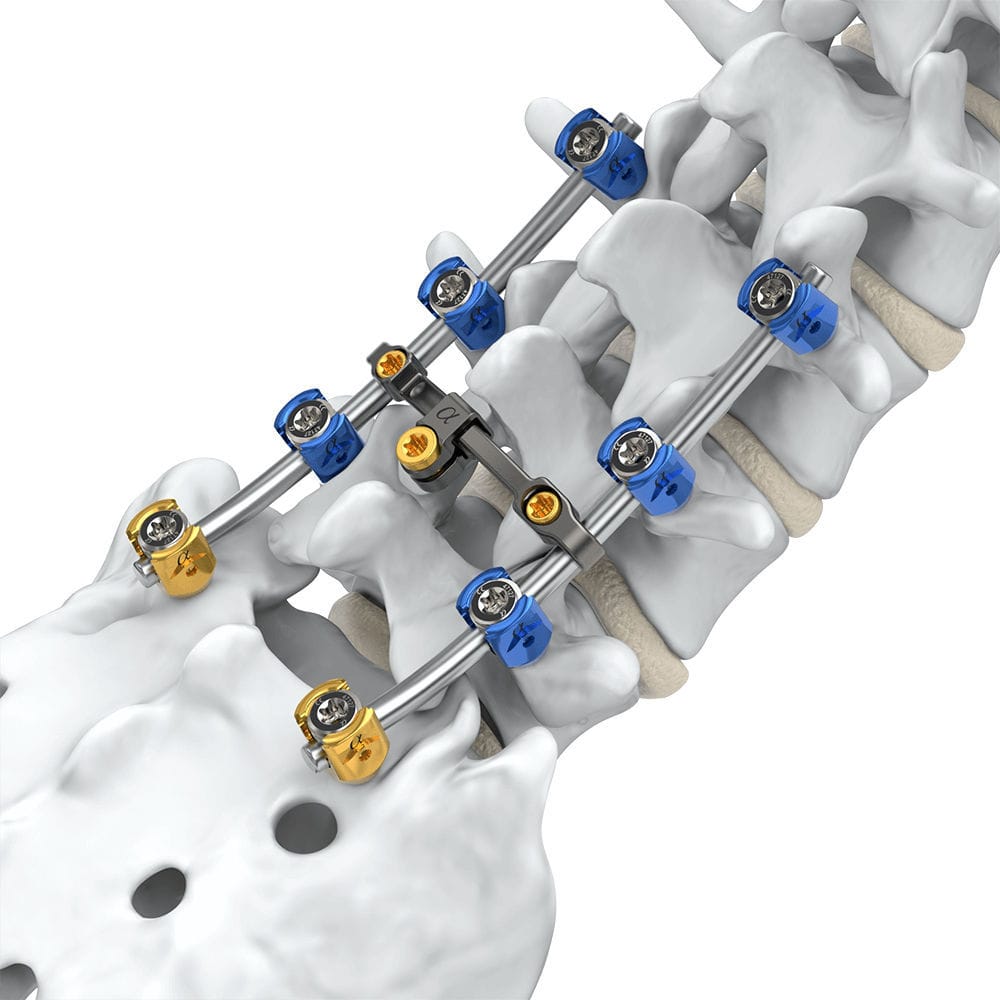 lumbo-sacral-osteosynthesis-unit-arsenal-alphatec-spine