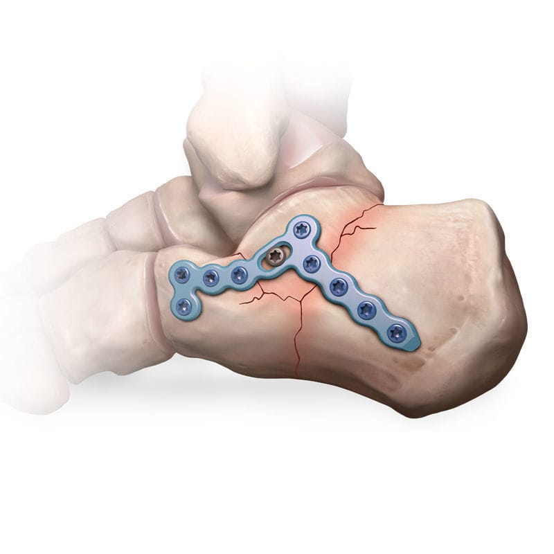 Calcaneus compression plate arthrex