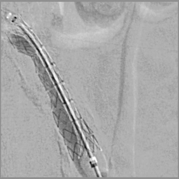 Peripheral stent graft VIABAHN® VBX Gore ePTFE