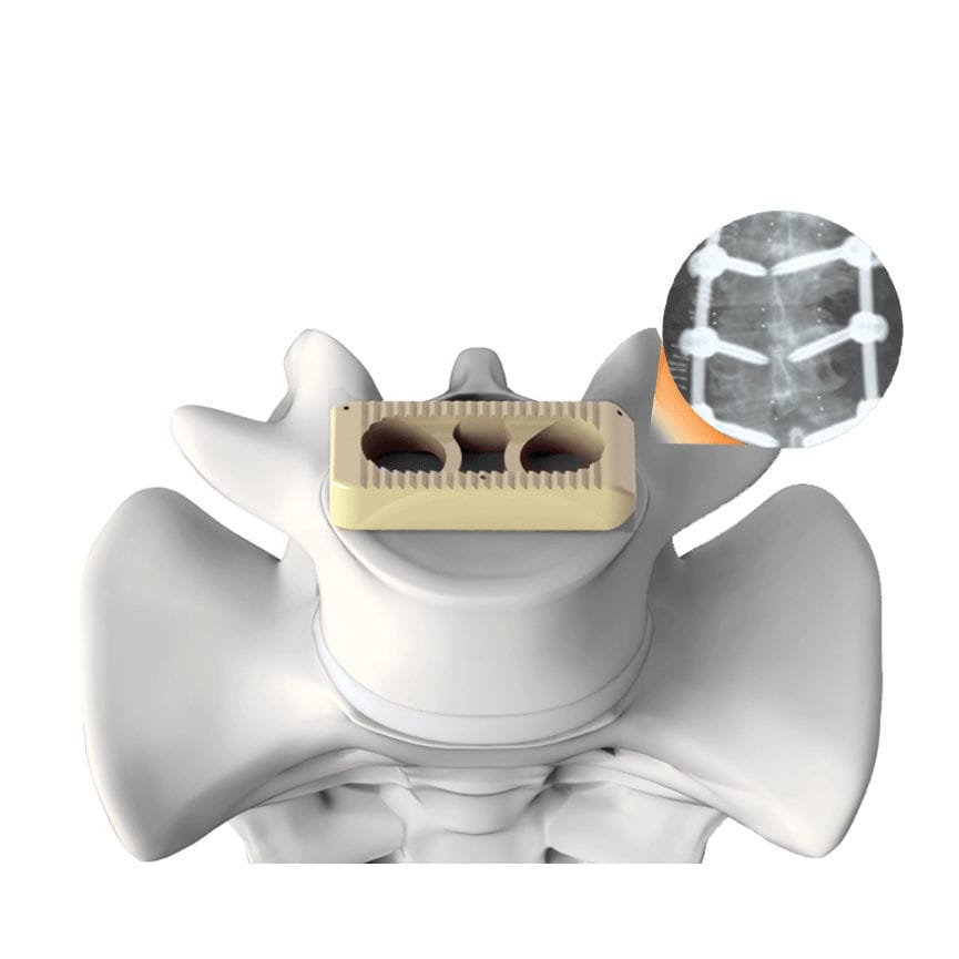 Lumbar interbody fusion cage - PLATEAU®-X - Life Spine - lateral