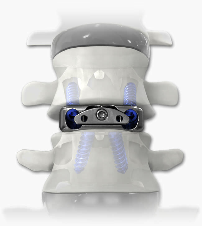 Cervical interbody fusion cage - DYNA-LINK® - Life Spine - anterior