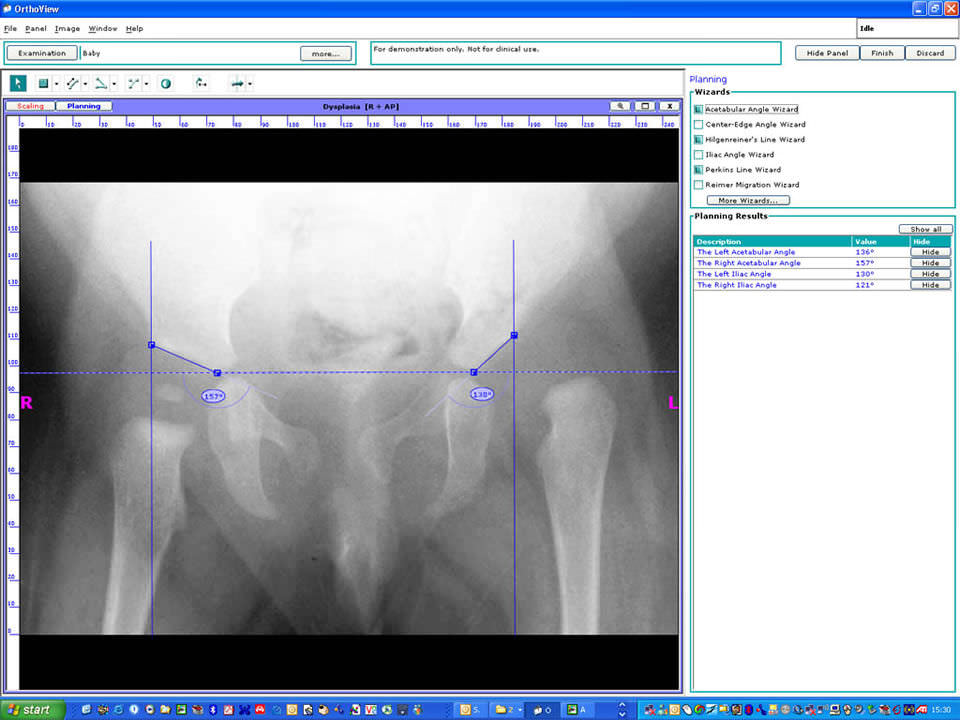 Preoperative planning software Hip Arthroplasty OrthoView for hip