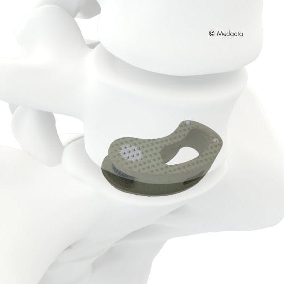 Thoraco-lumbar interbody fusion cage - MectaLIF® - Medacta - oblique ...