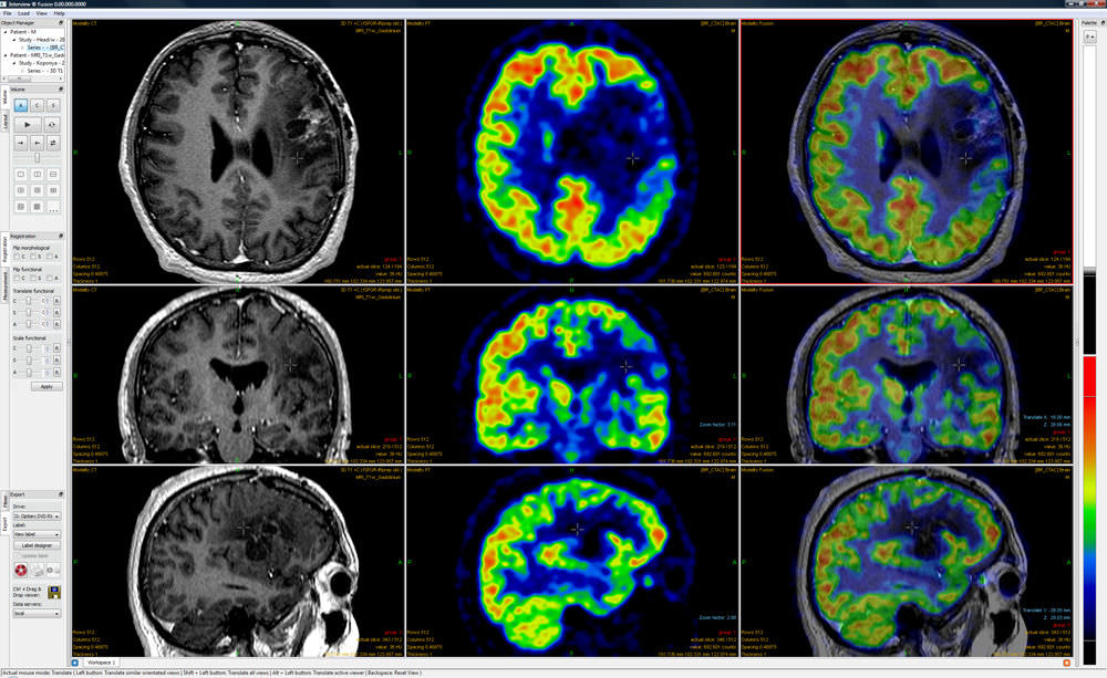 Multimodal image fusion software InterView™ FUSION Mediso medical