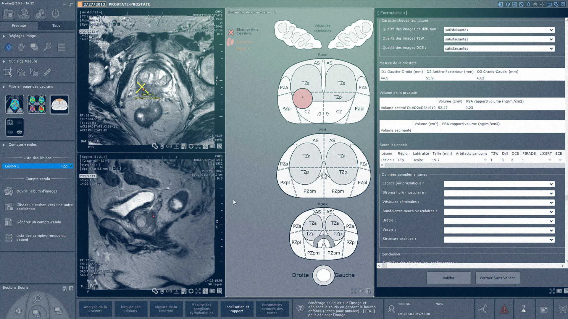 Analysis software module - Myrian® XP-Prostate - Intrasense ...