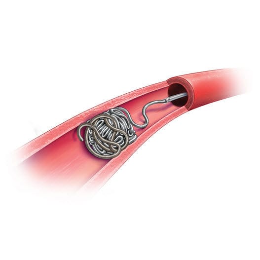 Peripheral catheter POD™ Penumbra